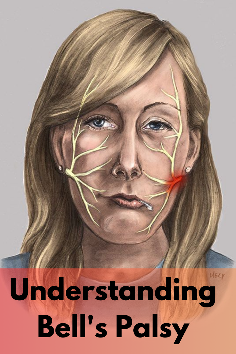 Bell S Palsy Bell S Palsy S Causes Symptoms And Treatment Healthcare Solutions